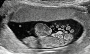 Jgct Juvenile Granulosa Cell Tumor (JGCT) – Cancer A-Z