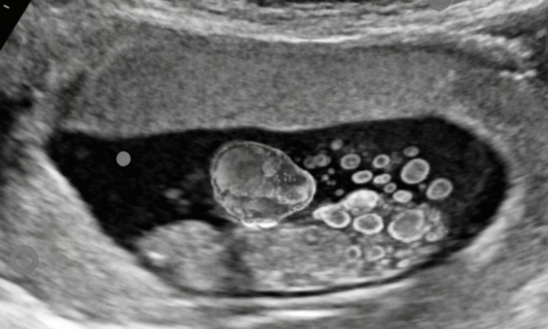 Jgct Juvenile Granulosa Cell Tumor (JGCT) – Cancer A-Z