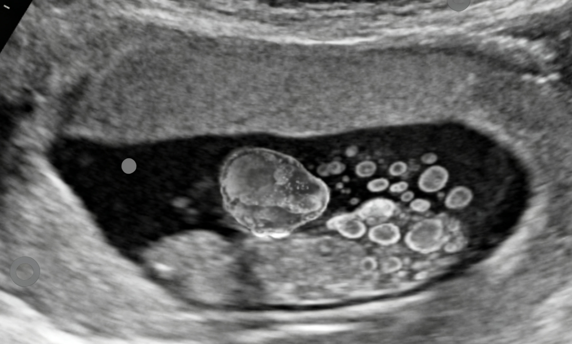 Jgct Juvenile Granulosa Cell Tumor (JGCT) – Cancer A-Z